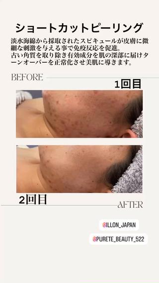 不純物の一切入らないショートカットピーリングでニキビをケアしていきます！ 