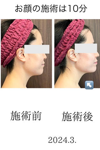 痛みのない筋膜リリースで、フェイシャルエステ
体験会のフェイシャルエステは変化が目で見てわかるように、椅子に座ったままの状態で施術をさせていただきます。
肩、肩甲骨周りからアプローチするため、しっかりケアができます。 