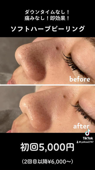 ★ダウンタイムなし・痛みなし★ソフトハーブピーリング

お仕事柄ダウンタイムが取れない方はソフトハーブで肌管理(*´-`)

ペースを守ってお手入れすることで、確実にニキビ軽減してまいります(*´ー｀*)

痛みストレスゼロ。ダウンタイムなし。

これでこの効果！と喜んでいただいております(*´꒳`*) 