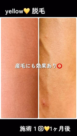 yellow.所属・yellow💛【 脱毛&フェイシャル】のエステ・リラクイメージ