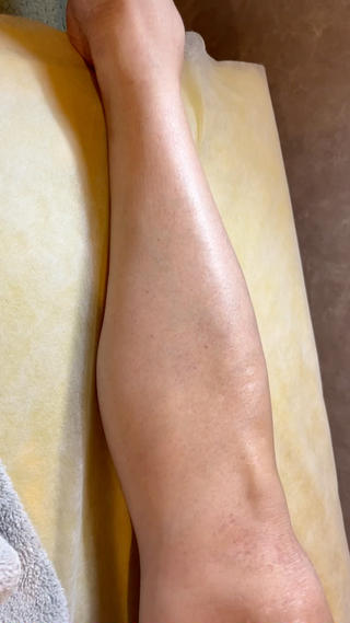 先日yellow4回目のお客様がご来店されました(´∀｀)

全身未処理で来てくださいましたが、全く生えてなくてツルツルなお肌でした！！

月1回ペースで通ってくださり、今では気になるのはおヒゲのみになりました★

気になるおひげも効果は実感してくださっており、抜け感もしっかり感じるとのこと。
しつこいおヒゲを中心に、30分脱毛に切り替えて進めていっております！

効果の高さに喜んでくださり、わたしもお肌を見せていただくたび感動しております(^^)

コスパが最高だと嬉しいお声もいただき幸せいっぱいです(*´∀｀*)

さらにツルツルなお肌目指して頑張ってまいりましょう！ 