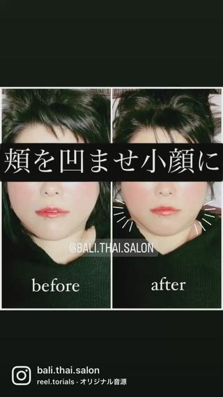 #小顔 #小顔矯正 #頬骨 