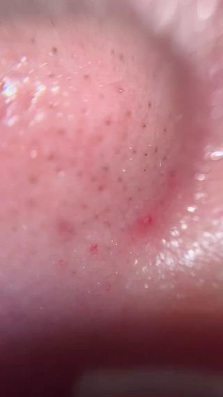 毛穴診断
ハイドラ毛穴レスコースのアフターです
毛穴がかなり小さくなりました！ 