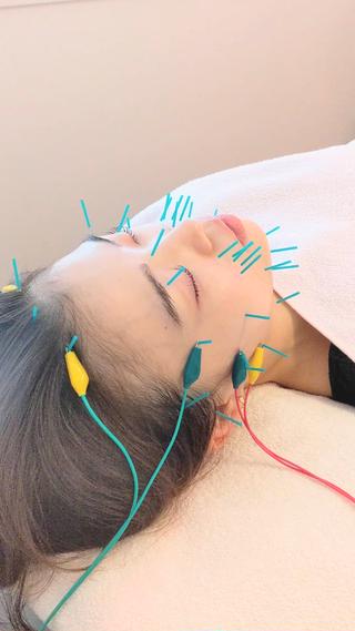 即効小顔美容鍼 