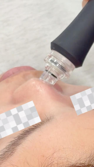 毛穴洗浄では、長年溜まった汚れを優しく水の力で吸引し
お肌の黒い角栓・白い角栓・詰まり毛穴・ザラつきを
スッキリ整えていきます
痛みやダウンタイムはなく、施術直後柄お化粧が出来ます◎ 