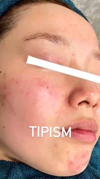 剥離ありハーブ、剥離なしハーブ、スキンケア、内服により改善

(株)三・一・五より症例引用 