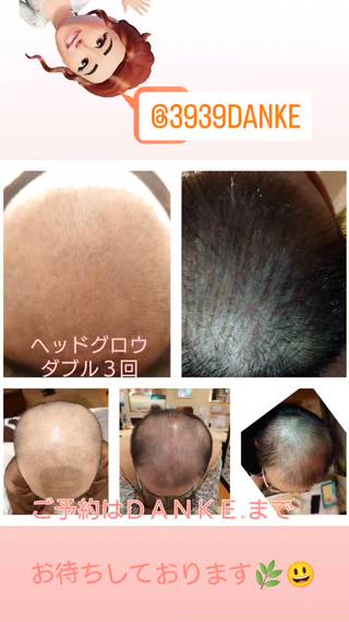 グリーンピール　ヘッドグロウ(ダブル)
 3回されたお写真です。

薄毛を気にされて、3年前にリ○ップを
使用されたのですが、
痒みなどで体質にあわず、
それ以降は放置されていらっしゃいました。

奥様のおすすめでご来店、
３回で写真のように変化されました。
まだ段階中のお写真ですが、
世の中のお悩みを持つ方に、
勇気を与えてください！
とのことで、
掲載画像させて頂いています。 