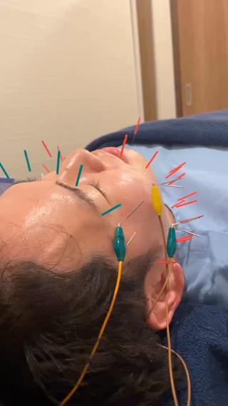 男性にも美容鍼人気です！ 