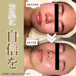 ニキビケアコース 