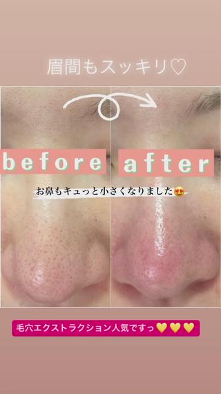 マスク解禁に向けて毛穴エクストラクションでケアしましょう
男性にも大人気です^ ^ 