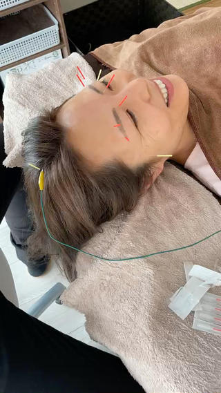 美容鍼一連の流れをタイムラプスで撮らせていただきました。フェイスパック中に身体の鍼で体調を整えています。 