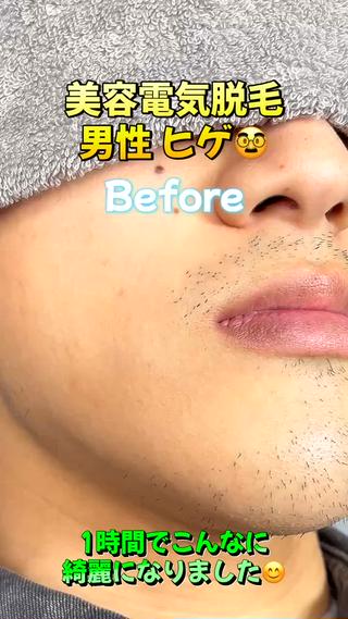 鼻下 ヒゲ 脱毛 美容電気脱毛(ニードル脱毛)