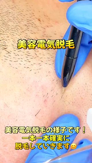美容電気脱毛の様子一本一本確実に脱毛してます!処理した毛からは、もう生えてきません!