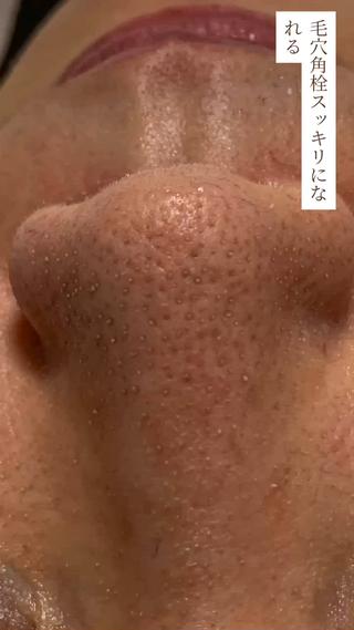 ハイドラフェイシャル♡ 