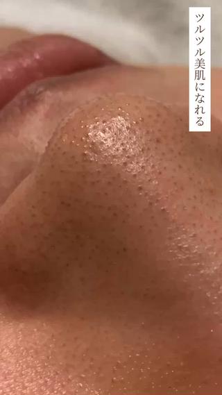 ハイドラフェイシャル
ハイドロピーリング 