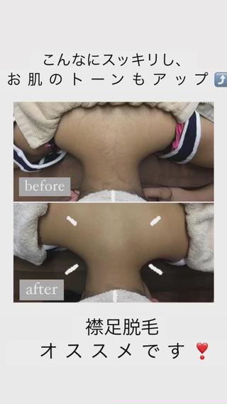 
こんにちは
dione栄店でございます

本日は襟足脱毛のご紹介

beforeとafterとで毛もしっかり減り、とてもスッキリ
してますプラスにお肌のくすみも飛ばしてくれるので
トーンアップも

周りから意外と見られてしまう襟足をスッキリしませんか

 