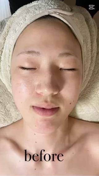 夏の紫外線ダメージや今までの蓄積をララピールで改善 