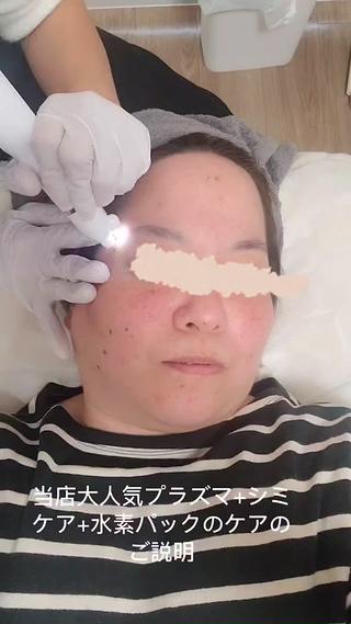 プラズマシミケアの施術動画です！ 