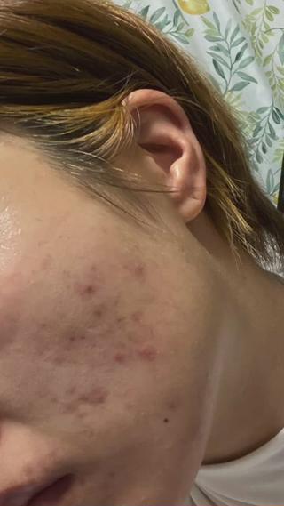 半年でお肌改善 