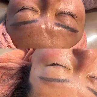 しみ、肝斑、そばかす、くすみ 