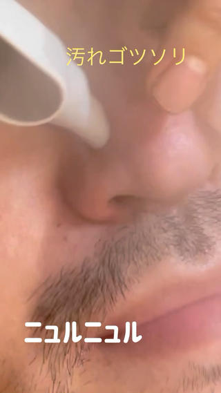 毛穴クリーニングで毛穴の汚れがでてきます 