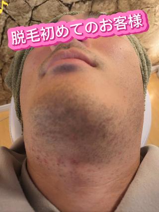 ヒゲ脱毛お客様！
脱毛デビュー
今後が楽しみです＼(^o^)／
乞うご期待 
