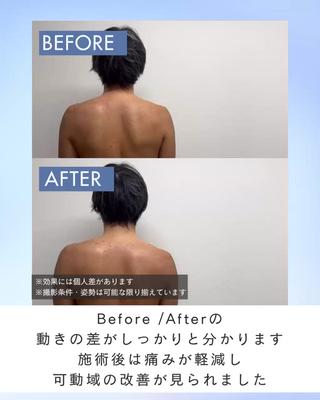 肩関節周囲炎のお客様です。
一度の施術で可動域がここまで変わります。