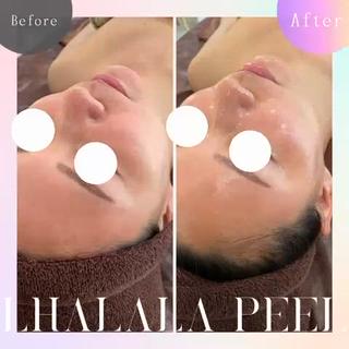 ララピール Before After ♪
韓国発祥の次世代ピーリングで肌管理を！ 