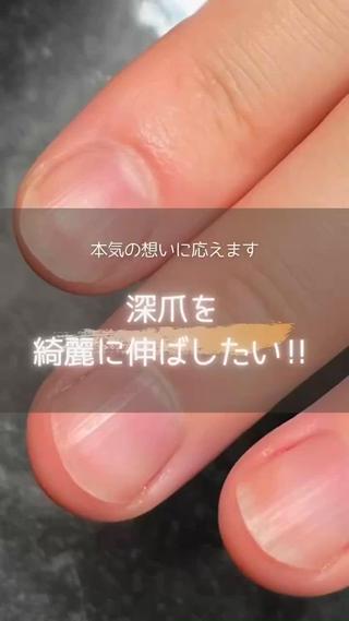 深爪緩和、自爪育成 