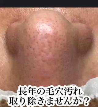 長年詰まりに詰まった汚れを放置しておくと、汚れがどんどん溜まり毛穴を押し広げて更に毛穴が広がります
そうなる前にキレイさっぱり取り除く事！大事です
定期的なケアで、広がった毛穴も徐々に小さくなり、汚れが溜まりにくいお肌になります
みなさん正しいケアできていますか？
毛穴エクストラクションtete式 で自分史上最高のお肌目指しましょう 