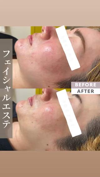 フェイシャルエステ

赤みがつよかった肌も一回のエステで、
だいぶ落ち着きました。
お家でもケアも取り入れてもらう事でより赤みや肌荒れ、
毛穴にも効果的です！！ 
