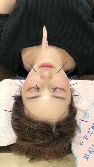 美容鍼ベーシックコース
美肌のお手伝い 