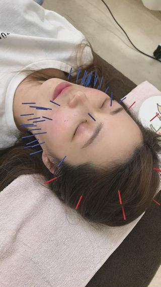 美容鍼を50本のコースになります 