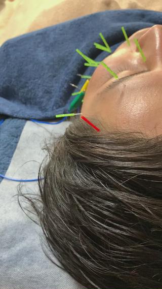 ニキビや肌荒れなど美容鍼は男性にもオススメです 