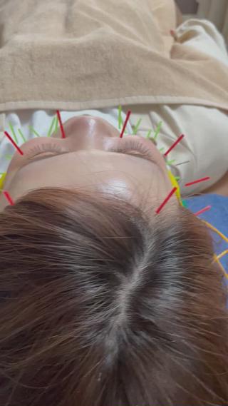 20代〜50代まで幅広い年齢層の方にご来院いただいています

シワやたるみ、むくみなど様々なお顔の悩みを改善いたします 