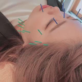 ベーシックな内容の基本の美容鍼☆

基本のポイントをしっかり押さえて
一人ひとりお悩みに合わせてケアします♪ 