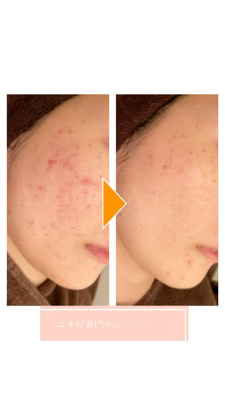 【こんなお悩みはありませんか？】
 
・皮膚科や、美容クリニックに通っても、ニキビが繰り返しできる
 
・薬や、抗生剤、ピーリングを続けて、赤みや乾燥がどんどん酷くなってしまった。
 
・ニキビ用化粧品や、高級な美容液など試しているが、効果を感じることができない。
 
・肌荒れが気になり、マスクを外して、人に顔を見られるのが、嫌だ。
 
このような方でも、あなたに合った、正しいケアをしていけば、必ずキレイになります。
 
たくさんのお客様のお肌をみていますが、同じニキビの症状の方は、一人も、いらっしゃいません。
 
ニキビの原因や、お肌質、今まで積み重ねてきたケアも、それぞれ違います。
 
ニキビ専門サロンアイナでは、個々に合わせたニキビケアで、健やかな素肌に導きます。

１人で悩まず、まずはご相談ください。
 