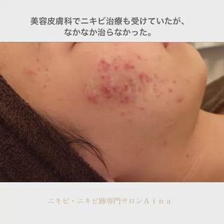 【美容皮膚科で変わらなかったニキビも、できなくなってきました】

ニキビがどんどん増えていき、治らない。
⁡
美容クリニックで治療を受けたり、ニキビに良いといわれるものを試したり、自分なりに頑張ってみた。
⁡
それでも思うように変わらないと、お越しいただきました。
⁡
全体的に膿んだ赤ニキビが出来ていたのが、落ち着いてきました。キメも細かくキレイに＾＾
⁡
ご自宅でも、お化粧品でのケアや、内側からの改善など、お伝えしたことを、コツコツ努力していただいた結果です。
⁡
サロンでのケアは、肌を傷つけることは、一切行いません。
⁡
もちろん、ダウンタイムもないので、ご安心ください。
⁡
これまでのたくさんの改善事例に基づき、あなたに合わせたケアを、ご提案致します。
⁡
これから先、ずっと付き合う、自分自身の肌。
⁡
今、真剣に向き合ってみませんか？ 