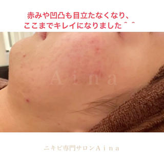 【ニキビ・ニキビ跡に、何年も悩まされていませんか？】

こんなお悩みは、ありませんか？
 
・皮膚科や、美容皮膚科に通っても、ニキビが繰り返しできる
 
・薬、抗生剤、ピーリングを続けて、赤みや乾燥がどんどん酷くなってしまった

・ニキビ用化粧品や、高級な美容液など試しているが、効果を感じることができない

・ニキビが気になり、人に顔を見られるのが、嫌だ

・朝のメイクに、コンシーラーやファンデーションを厚塗りしてしまい、時間がかかる

・すっぴんを見られるのが嫌で、温泉や、泊まりの旅行に行きたくない

・友達や、周りの人の肌が、キレイで羨ましい

・クレーターや、色素沈着したニキビ跡を治すために、時間もお金もたくさんかけてきた

このような長年の肌トラブルから、たくさんのお客様が、卒業しています。

何年も悩んでいるものが、すぐになくなることはありません。

ただ、あなたに合わせたケアを続けていけば、必ずキレイになりますよ＾＾ 
