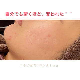 【皮膚科に通ってもなくならないニキビが、自分でも驚くほど変われました】

皮膚科に通ったり、色んな化粧品を試しても変わらなかった。

そんな方でも、ここまでキレイな素肌に

一時的に、プツプツとニキビが出てきたこともありましたが、
諦めずにケアを続けていただいた結果、ここまで改善。

何年も悩んでいたニキビを、たった数日で治す魔法はありません。

大人ニキビには、色々な原因が隠れているからです。

二人三脚で、改善して見つけていきましょう

メニュー詳細、お客様からいただいたお声は、プロフィールＵＲＬのホームページから、
ご覧いただけます。

@aina.beauty.salon

１０月〜１１月　満員御礼

ご新規様のご予約は、１１月２５日（木）２１時のメルマガにて、先行受付致します。

ご希望の方は優先案内フォームへ、ご登録ください。

リピーター様は、別にご予約枠がございますので、常時受付可能です。

=============

ニキビ・ニキビ跡専門サロンＡｉｎａ

横浜市神奈川区（東横線 白楽駅徒歩５分）

=============

神奈川県、東京都、埼玉県、栃木県、千葉県、静岡県などから、お越しいただいてます。 