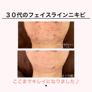 【３０代のフェイスラインニキビ、ここまで落ち着きました】

フェイスラインを中心に、ニキビが急に増えてしまったお客様。

今は、凹凸も目立たなくなり、硬くなっていたニキビの箇所も、ふっくらと柔らかい素肌に

たった４ヶ月でここまでキレイになったのは、サロンでのケアと、ご自宅でも化粧品やインナーケアを、コツコツ行っていただいたから。

繰り返す肌トラブルを改善したいなら、朝晩、毎日行うスキンケアを正しく行う。

そして、食生活、生活習慣の見直しもしていくことで、改善のスピードも上がります♪

理想の素肌づくりを、精一杯、お手伝いします＾＾
 