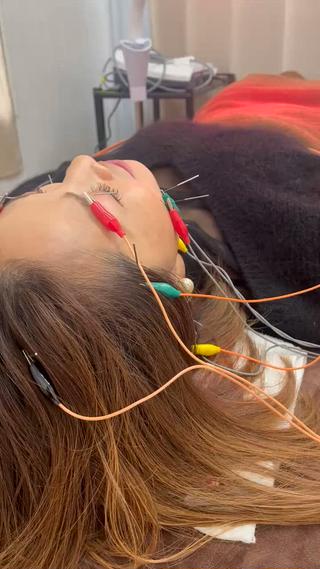 電気を流す美容鍼。
噛み締め、お顔の浮腫みなどお悩みに対してケアしていきます。 