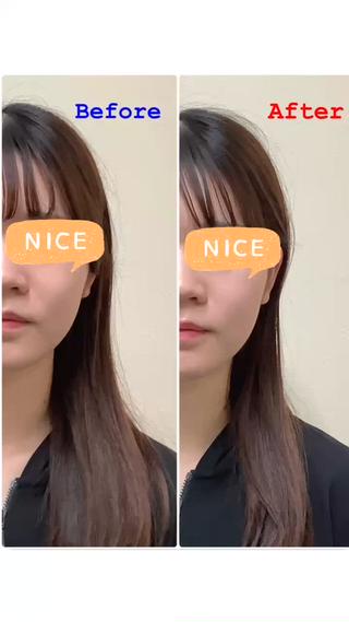 美容鍼+小顔矯正
Before→After 