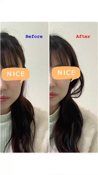 美容鍼+小顔矯正
Before→After 