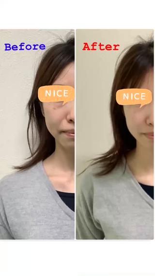 美容鍼
Before→After 