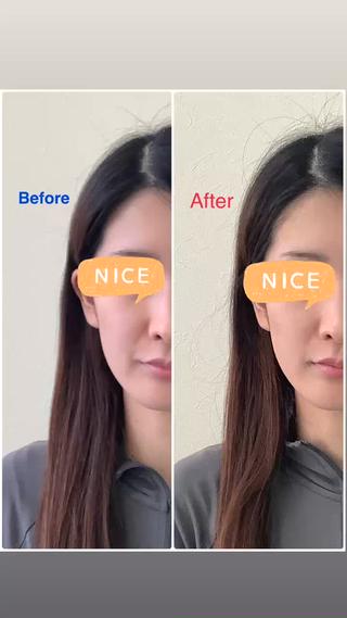 美容鍼+小顔矯正

Before→After 