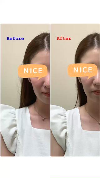 美容鍼+小顔矯正
Before→After 