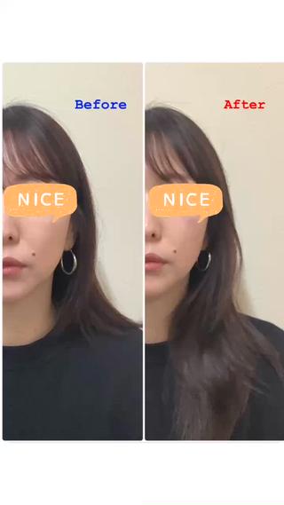 美容鍼+小顔矯正
Before→After 