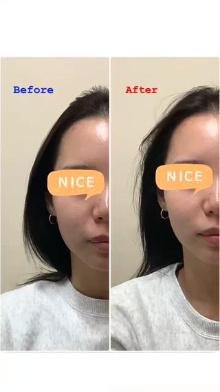 小顔矯正
Before→After 