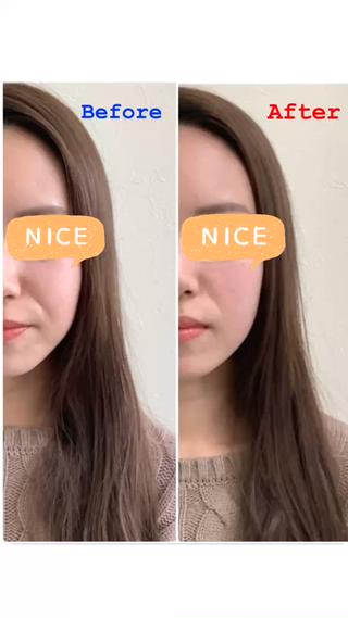 美容鍼+小顔矯正
Before→After 